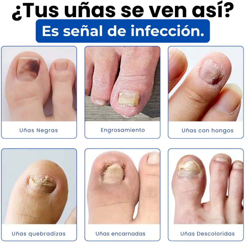 Fungal Nail